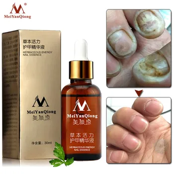 MeiYanQiong Копър Лечение За нокти Масло За Премахване на Гъбички на Ноктите на Лечебното Копър Против Инфекции Паронихии 30 мл